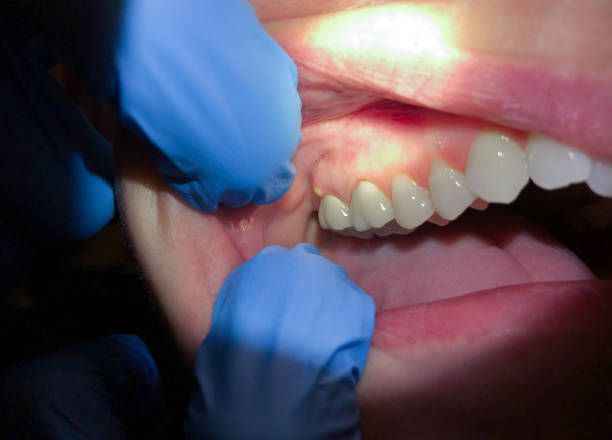 Best Emergency Care for Gum Disease in USA